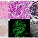 NAVIGATING TREATMENT OPTIONS AND PROGNOSIS FOR FIBRILLARY AND IMMUNOTACTOID GLOMERULOPATHIES