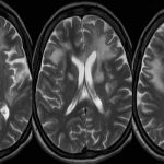 EXPLORING THE ETIOLOGICAL FACTORS BEHIND PROGRESSIVE MULTIFOCAL LEUKOENCEPHALOPATHY