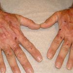 PORPHYRIA CUTANEA TARDA: KEY INSIGHTS AND CLINICAL MANAGEMENT STRATEGIES