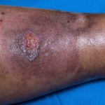 AN IN-DEPTH ANALYSIS OF PYODERMA GANGRENOSUM: FROM CLINICAL PRESENTATION TO CARE STRATEGIES