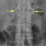 CLINICAL INSIGHTS INTO SERONEGATIVE SPONDYLOARTHROPATHIES: UNDERSTANDING AND MANAGING THE CONDITION
