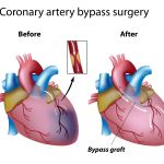 WHAT YOU NEED TO KNOW ABOUT CORONARY ARTERY BYPASS GRAFTING PROCEDURES