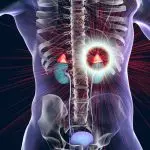 COMPREHENSIVE GUIDE TO SYNDROME OF INAPPROPRIATE ANTIDIURETIC HORMONE SECRETION