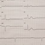 COMPREHENSIVE OVERVIEW OF SICK SINUS SYNDROME: FROM ETIOLOGY TO EFFECTIVE MANAGEMENT