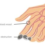 ESSENTIAL FACTS ABOUT THROMBOANGIITIS OBLITERANS
