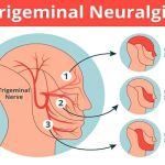 TRIGEMINAL NEURALGIA EXPLAINED: AN IN-DEPTH EDUCATIONAL RESOURCE