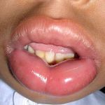 FROM PATHOPHYSIOLOGY TO MANAGEMENT: A DEEP DIVE INTO DIAGNOSING AND TREATING ANGIOEDEMA