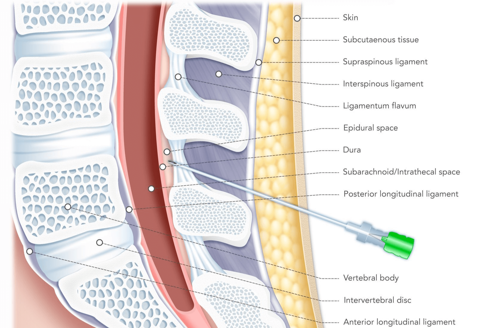 PATHOPHYSIOLOGY, PREVENTION, AND MANAGEMENT OF POST-DURAL PUNCTURE HEADACHE