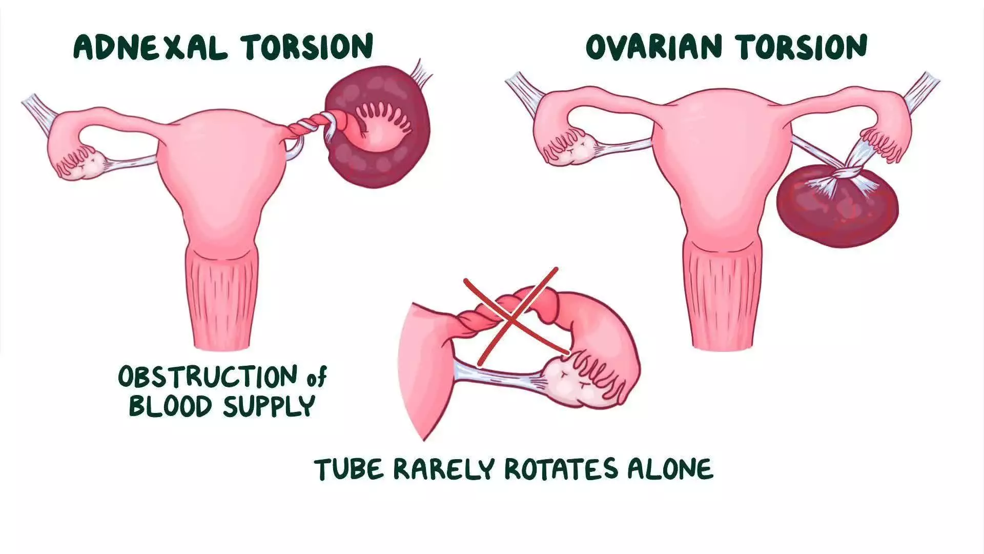 THE ULTIMATE GUIDE TO MANAGING ADNEXAL TORSION: FROM SYMPTOMS TO SURGICAL SOLUTIONS