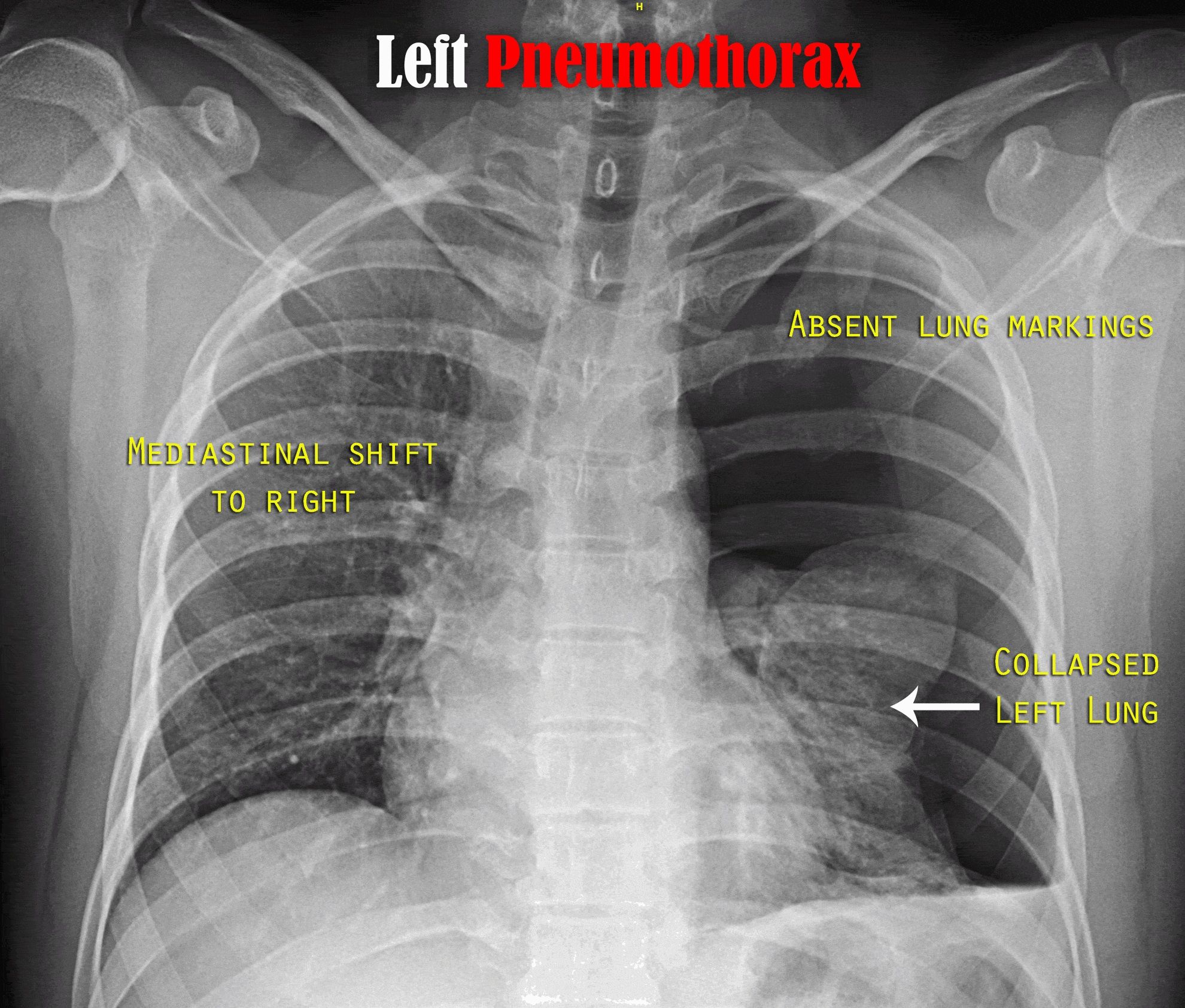 PEDIATRIC RADIOLOGY: CHEST PEDIATRIC RADIOLOGY: CHEST