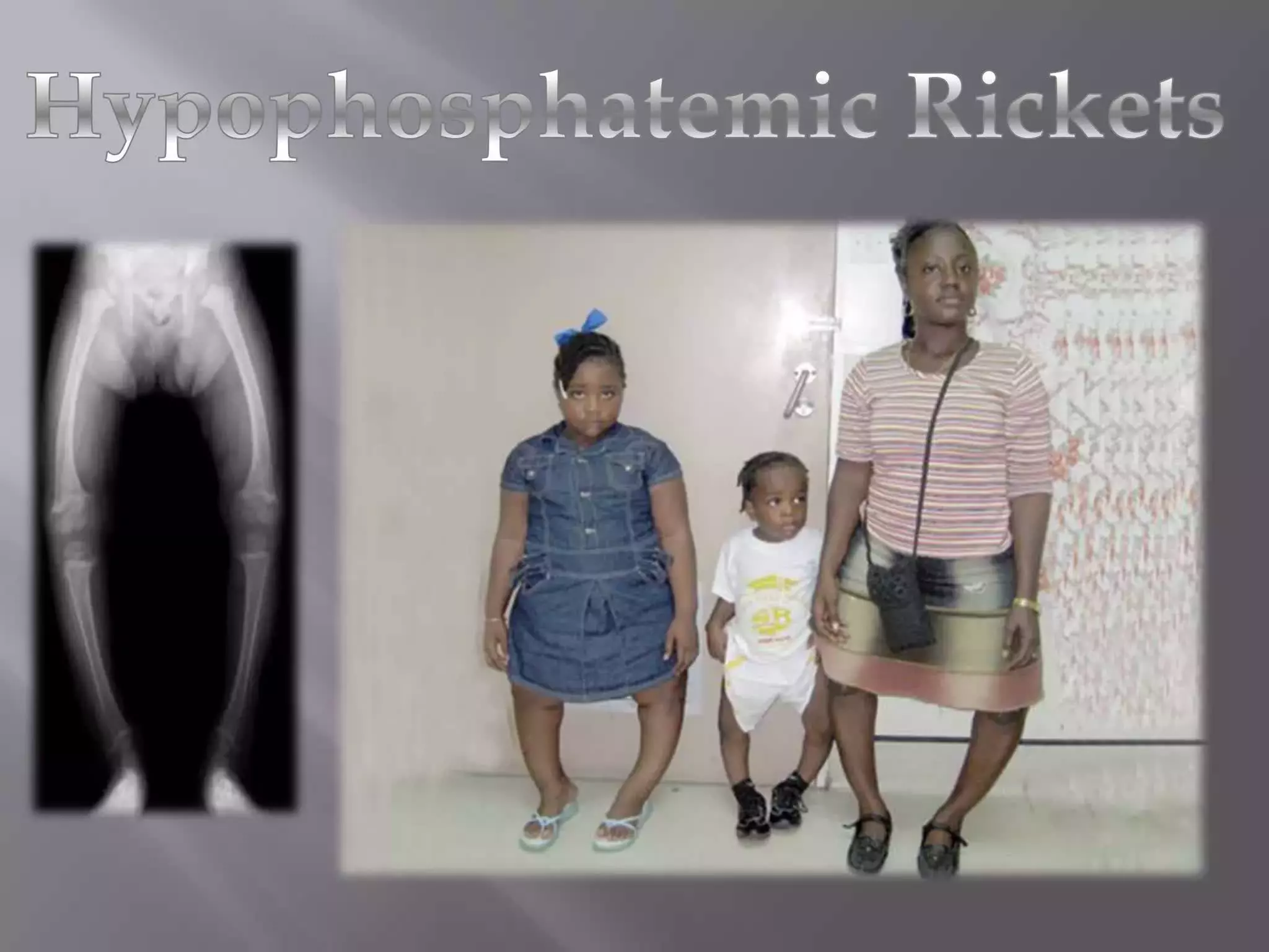 Blood Ph Rickets A THOROUGH GUIDE TO HYPOPHOSPHATEMIC RICKETS: FROM EARLY SIGNS TO ...