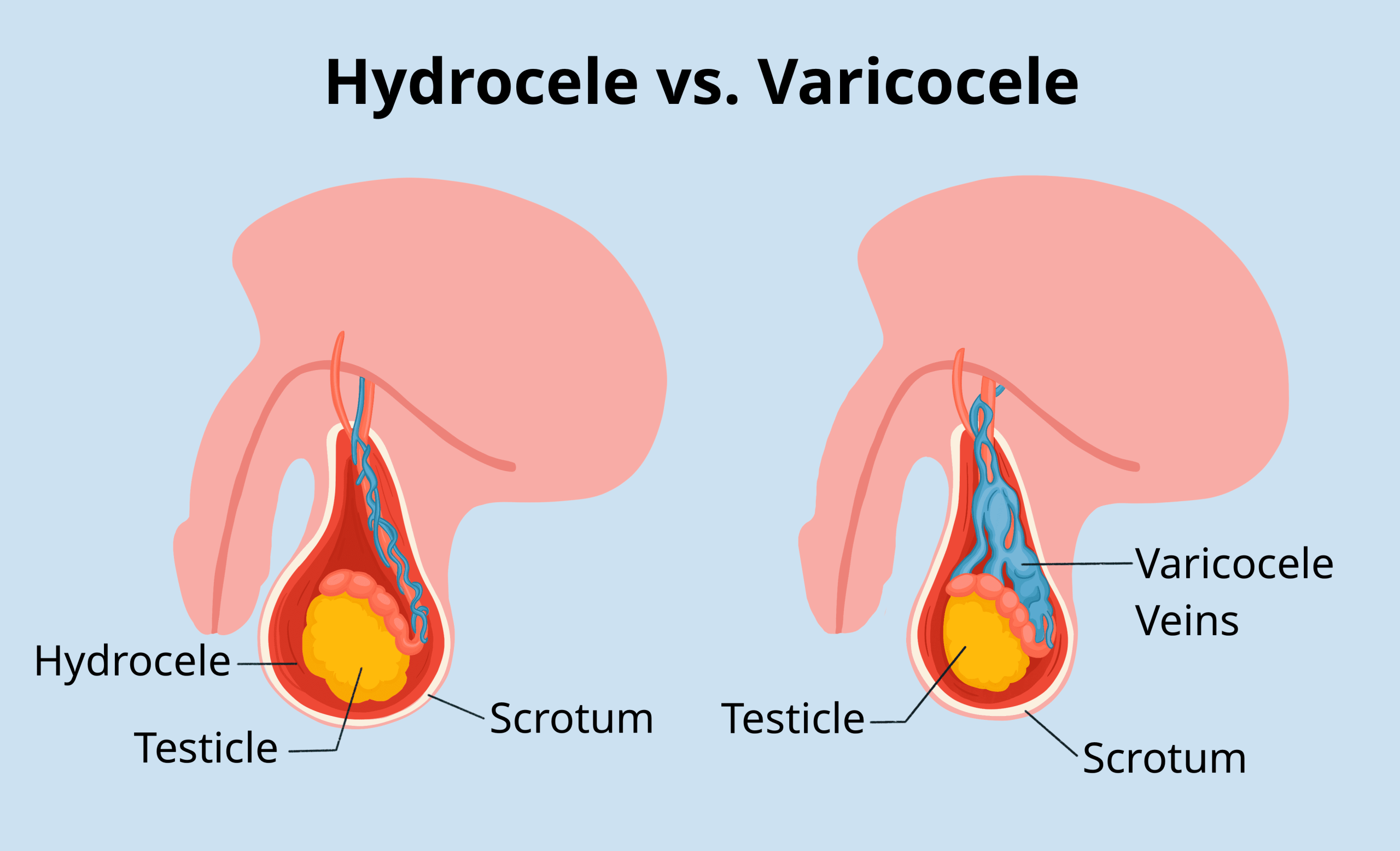 SURGICAL MANAGEMENT STRATEGIES FOR HYDROCELE AND VARICOCELE: WHAT YOU NEED TO KNOW