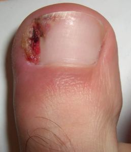 An ingrown toenail which is red and swollen