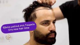 Έκανα μεταμόσχευση μαλλιών στη Τουρκία (now hair time)