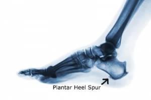 An x-ray showing a plantar heel spur