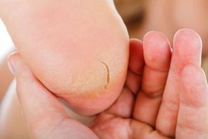 A human heel resting in a hand, the heel has a crack in it