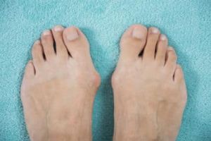 A picture of 2 feet with bunions on a blue background