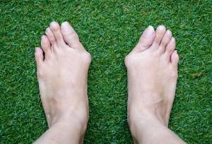 A pair of feet with severe bunions