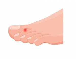 A drawing of a hammer toe