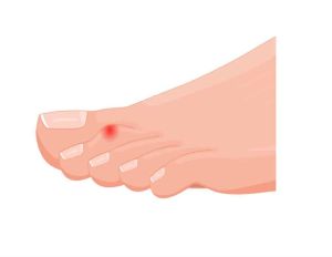 A drawing of a hammer toe