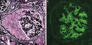 A COMPLETE OVERVIEW OF ANTI-GLOMERULAR BASEMENT MEMBRANE DISEASE | MY ...