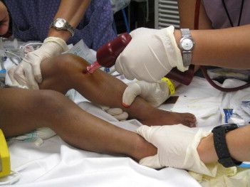 INTRAOSSEOUS LINE PLACEMENT: A POWER DRILL APPROACH FOR QUICK ACCESS