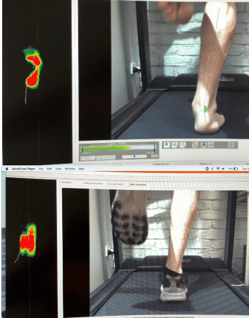 A comparison of gait with and without orthotics and shoes.