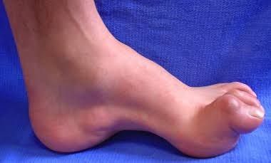 COMPREHENSIVE INSIGHT INTO HEREDITARY NEUROPATHIES: TYPES, SIGNS, AND CARE STRATEGIES