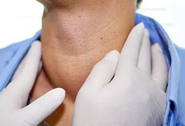 SWELLINGS OF THE NECK