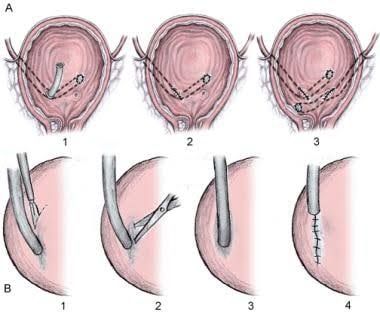 THE URETER IMPLANT PROCESS AND ITS DEPENDENCE ON GOOD BLOOD FLOW