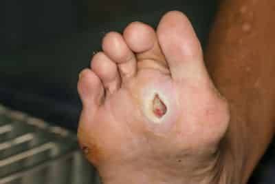 A neuropathic ulcer on the bottom of the ball of a foot.