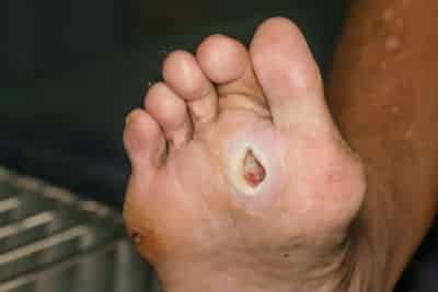 A neuropathic ulcer on the bottom of the ball of a foot.