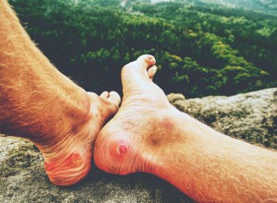 A man's feet are near the edge of a cliff with blisters on the back of the heels.