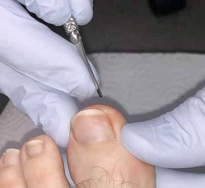 A Podiatrist can Help with Your Ingrown Toenails