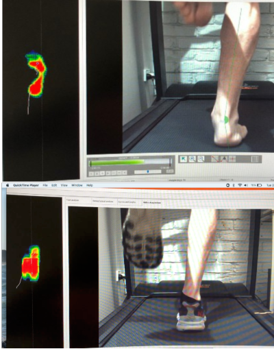 Two images of a lower leg and foot on a treadmill showing one without shoes and one with shoes and orthotics. The difference is in how much the orthotics prevent excess flattengin of the arch.