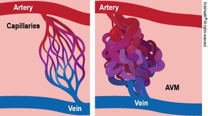 UNDERSTANDING NEUROVASCULAR MALFORMATION: A GUIDE FOR PATIENTS