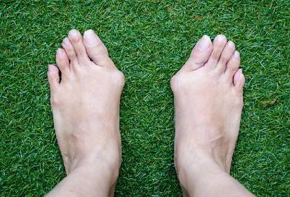 A pair of feet with severe bunions
