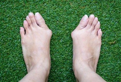 A pair of feet with severe bunions