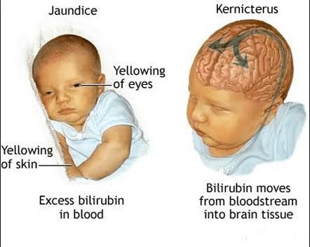 NEONATAL JAUNDICE MANAGEMENT: BEST PRACTICES FOR HEALTHCARE PROVIDERS