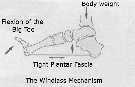 A diagram of the windlass mechanism showing flexion of the big toe and tightening of the plantar fascia