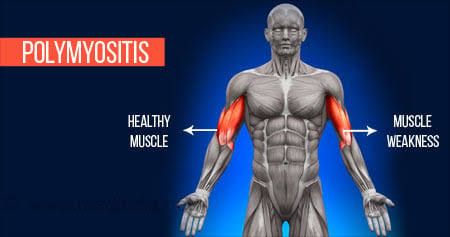EFFECTIVE MANAGEMENT STRATEGIES FOR POLYMYOSITIS AND DERMATOMYOSITIS