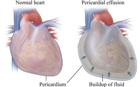 A CLOSER LOOK AT PERICARDIAL DISEASES