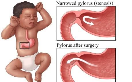 PYLORIC STENOSIS: IDENTIFYING CLINICAL SIGNS FOR EARLY INTERVENTION