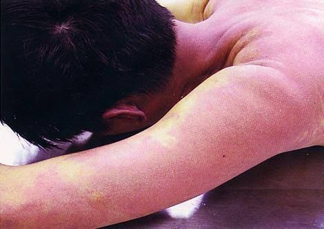A CLOSER LOOK AT CARBON MONOXIDE POISONING