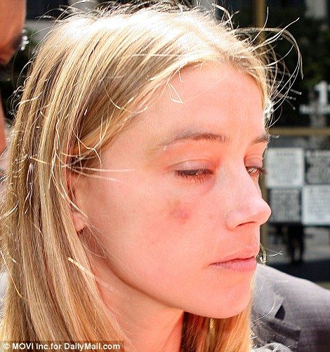 34B3E93C00000578-3613134-Amber_Heard_bruises-a-88_1464379672727