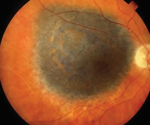 IDENTIFYING CLINICAL FEATURES OF CHOROIDAL MELANOMA: WHAT CLINICIANS NEED TO KNOW