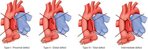 A COMPREHENSIVE GUIDE TO AORTOPULMONARY WINDOW: PATHOPHYSIOLOGY ...