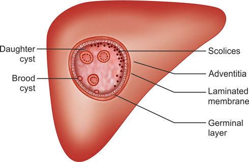 EMERGING TRENDS IN HYDATID CYST RESEARCH AND THERAPY