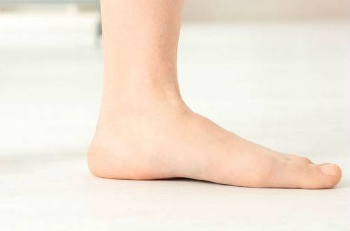 A flat foot shown from the medial side with virtually no arch at all