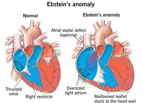 CLINICAL PRESENTATION OF EBSTEIN ANOMALY: WHAT TO LOOK FOR IN DIAGNOSIS